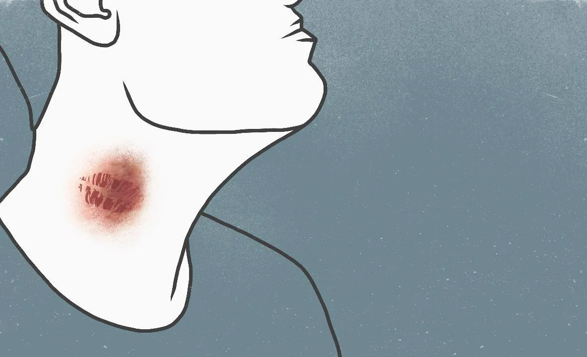 Hickey là gì? Cách tạo Hickey và xóa Hickey đơn giản, an toàn nhất