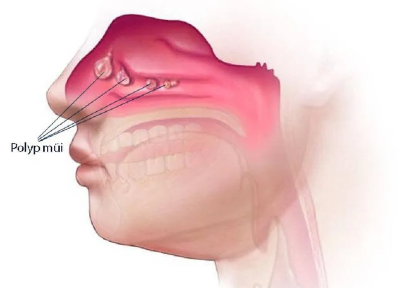 Nguyên nhân, ảnh hưởng và cách làm giảm nghẹt mũi khó ngủ  tại nhà nhanh nhất