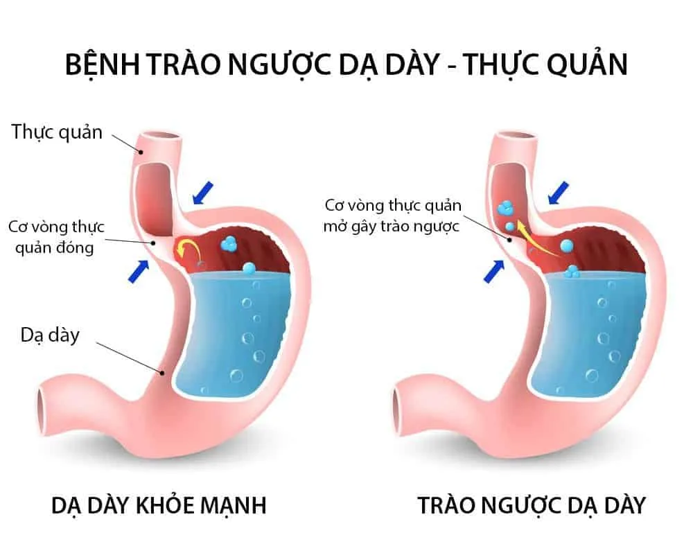 Tư thế ngủ cho người bị trào ngược dạ dày là gì?