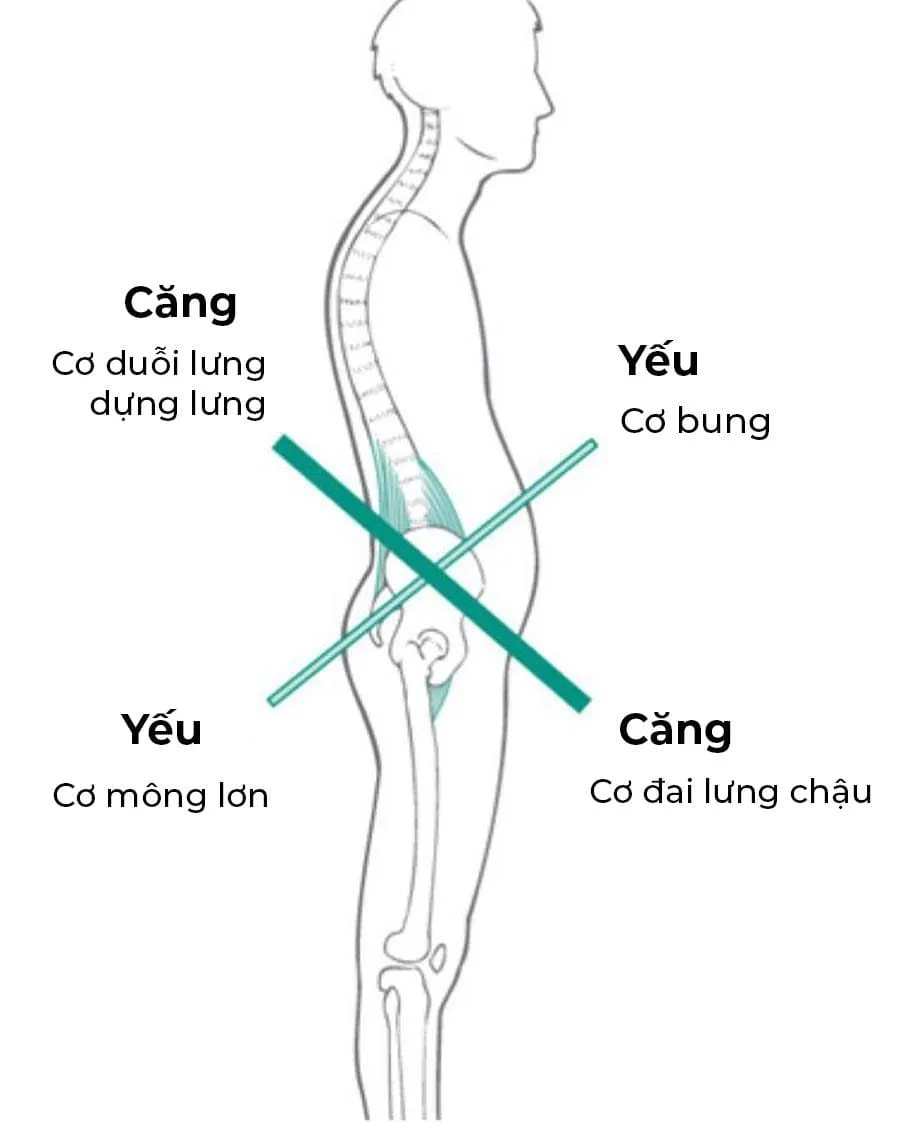 Võng lưng là gì? Cách khắc phục tình trạng võng lưng